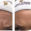Choice Of Botox Injections National Deal - Image 3