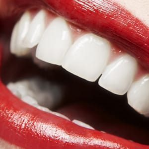 Or Laser Teeth Whitening Dubai