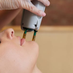 Carbon Laser Treatment