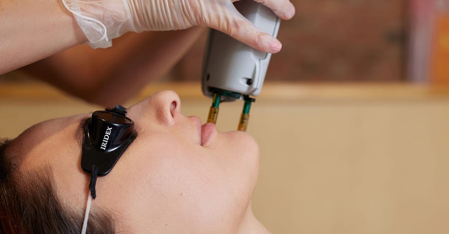 Carbon Laser Treatment