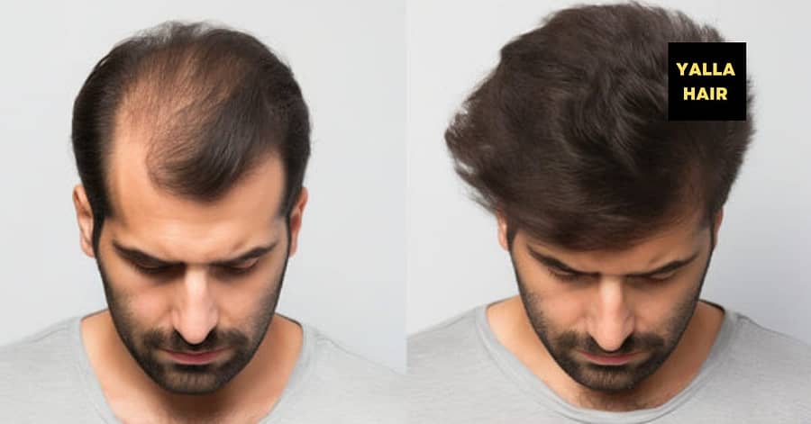 Extensions / Feathering Dubai